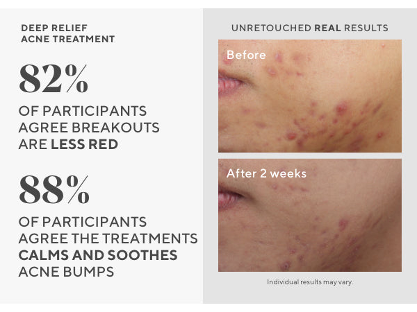 Murad – Control Acné Deep Relief Blemish Treatment